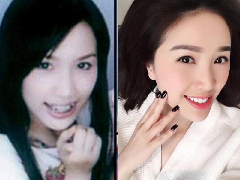 bao-thy-tung-stress-nang-vi-bi-nghi-phau-thuat-tham-my