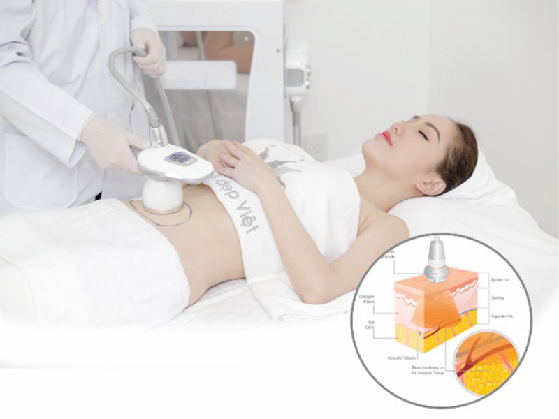 eo-thon-nho-cong-nghe-giam-mo-bung-cavi-deluxe