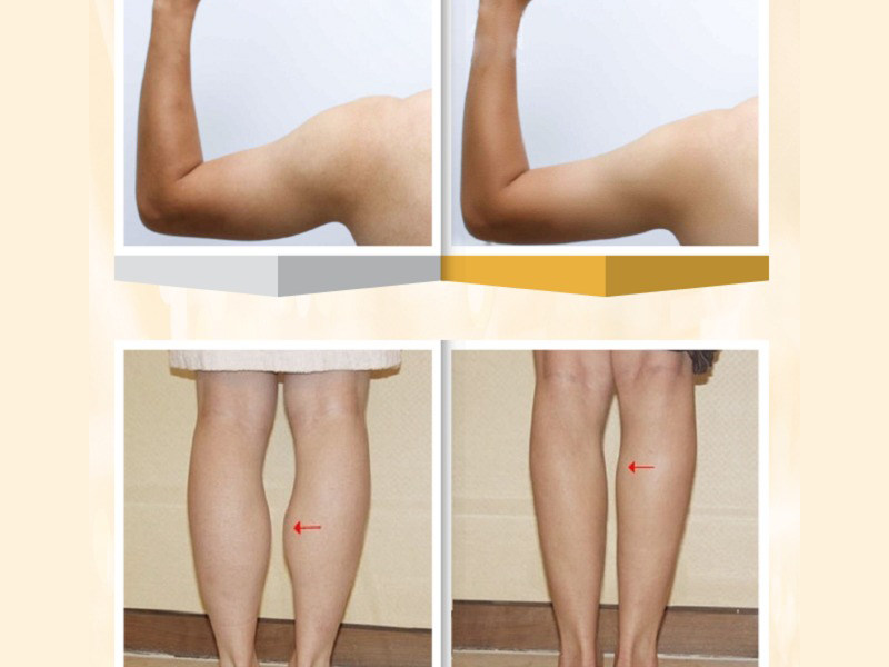 giam-mo-thua-bap-tay-bap-chan-khong-phau-thuat