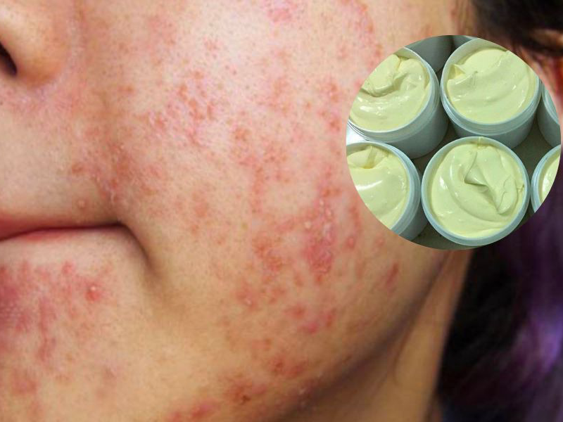 kem-tron-tan-pha-lan-da-nhu-the-nao