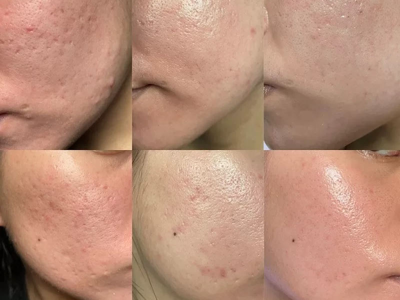 khac-phuc-seo-lom-bang-nang-luong-lazer