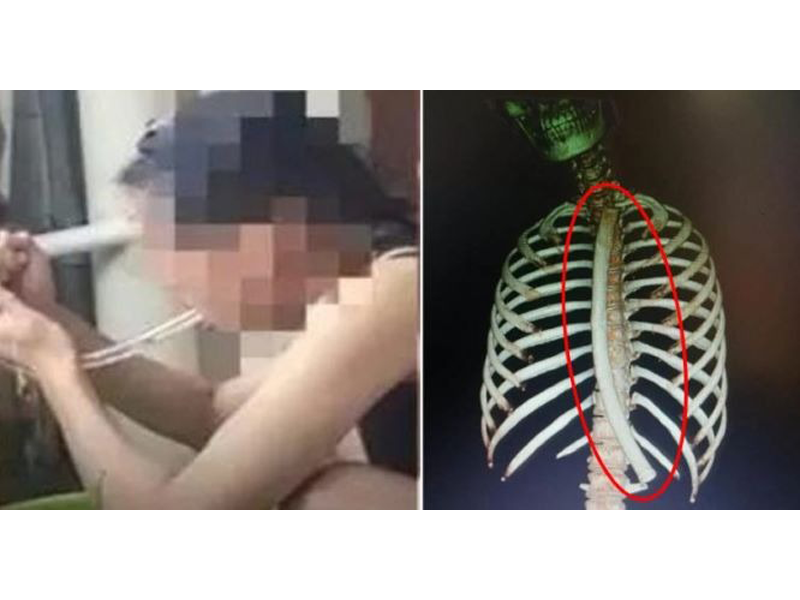 kinh-di-cam-thang-ong-hut-vao-da-day-de-giam-can