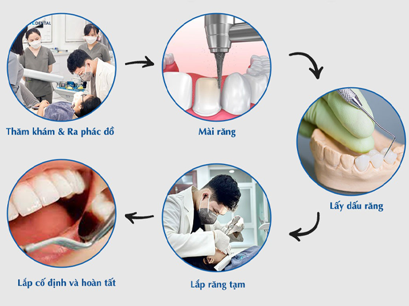 nha-khoa-fine-dental-dia-chi-boc-rang-su-tham-my