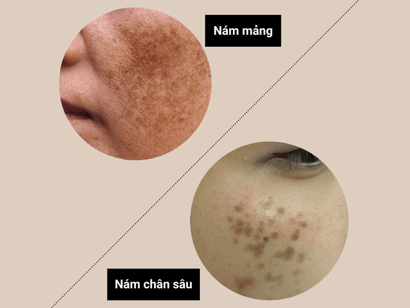 nhan-biet-nam-nong-va-nam-sau