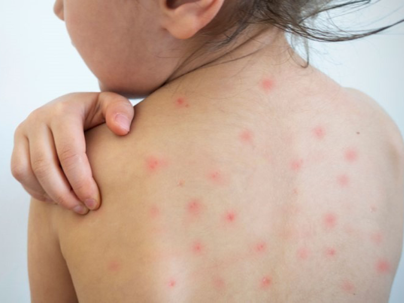 nhung-benh-thuong-gap-o-tre-ngay-he