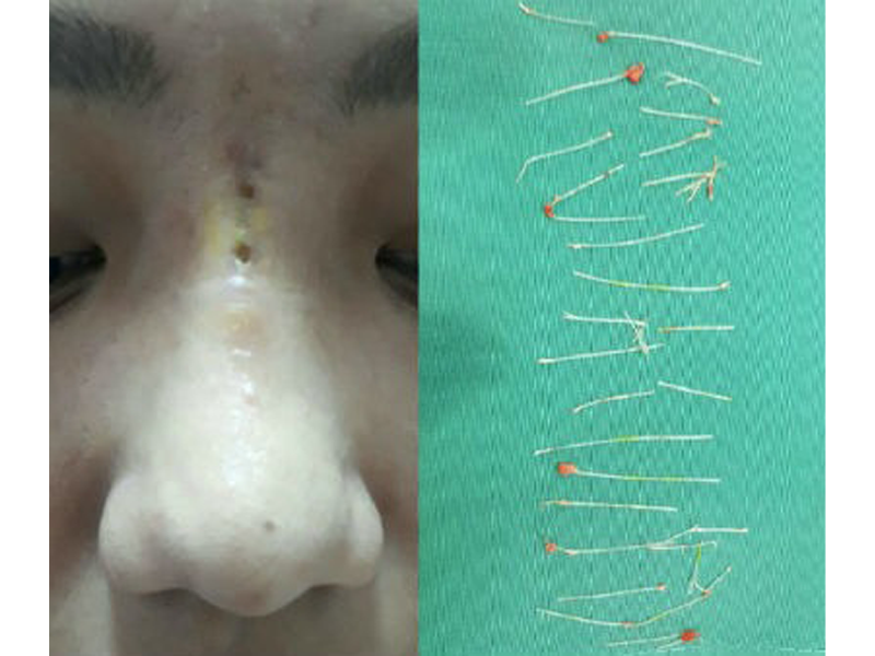 om-han-khi-chi-hang-tram-trieu-xuat-ngoai-sua-mui