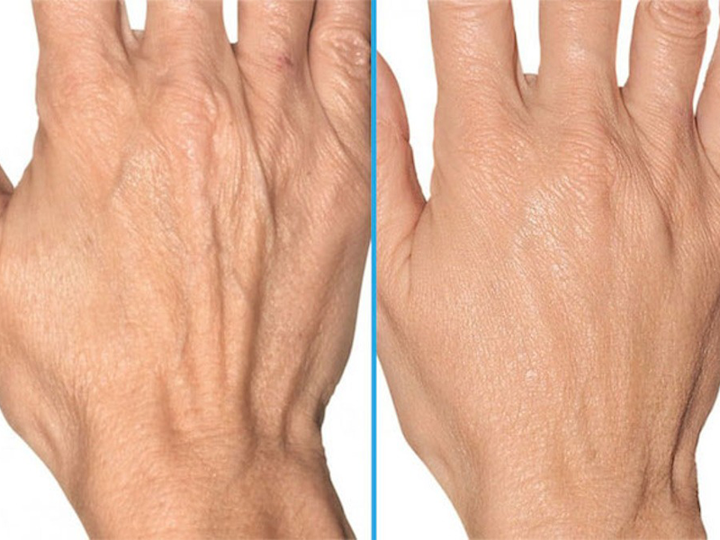 tre-hoa-ban-tay-theo-phuong-phap-filler