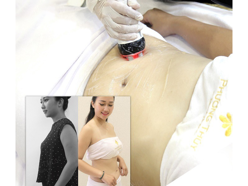 xu-huong-lam-dep-giam-mo-khong-can-phau-thuat