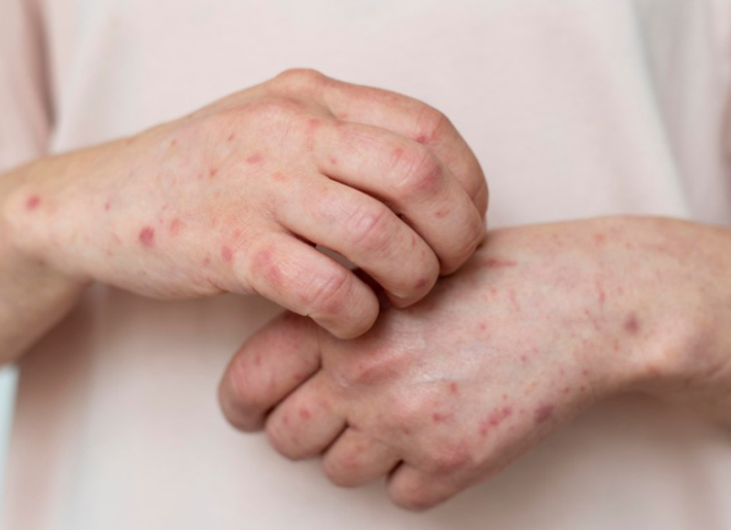 ban-soi-co-gay-ngua-khong-hieu-ro-trieu-chung-va-cach-giam-kho-chiu