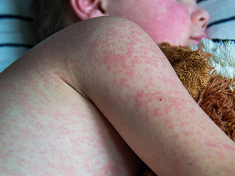 benh-soi-o-tre-em-hieu-de-phong-ngua-va-bao-ve-tre-khoi-can-benh-truyen-nhiem-nguy-hiem