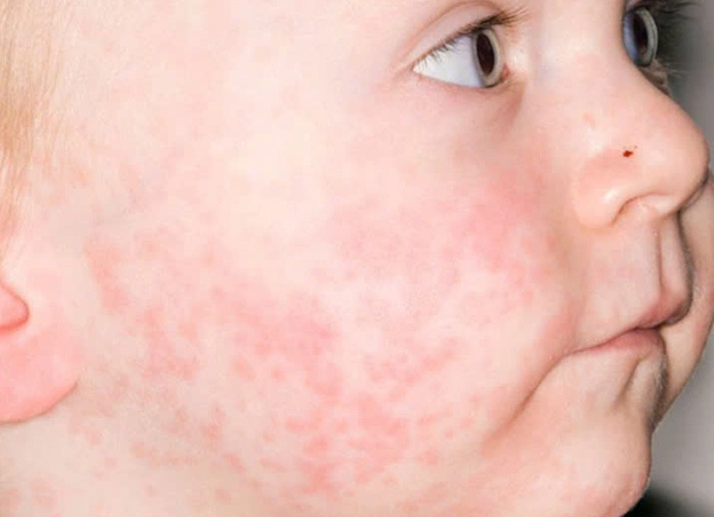 benh-soi-o-tre-em-hieu-de-phong-ngua-va-bao-ve-tre-khoi-can-benh-truyen-nhiem-nguy-hiem